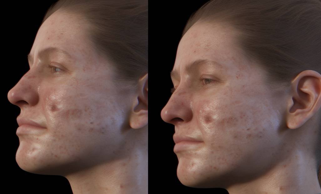 chin blackheads